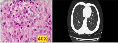 Association of circulating tumor cells and IMP3 expression with metastasis of osteosarcoma